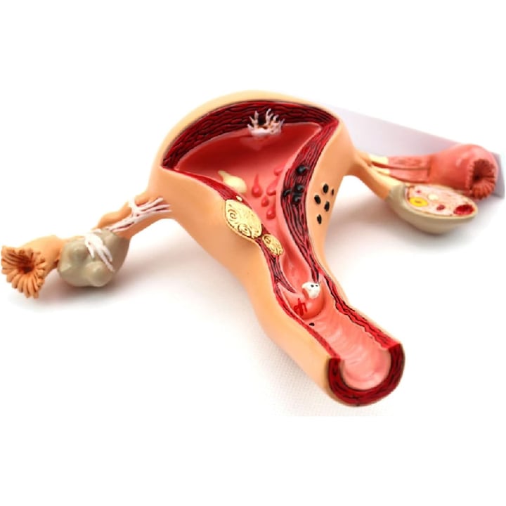 Model de leziune uterina WALALLA model de anatomie umana 6.7x3.5x8.9 inch material PVC culoare bej vintage