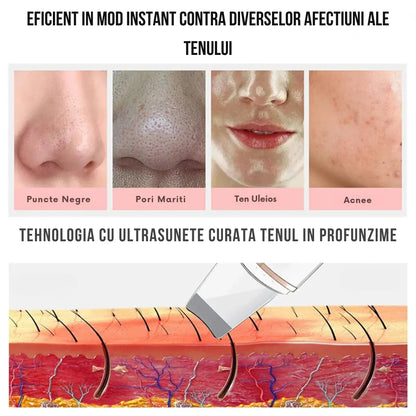 Aparat de Curatare Faciala cu Ultrasunete, ClearSkin, Indepartare Puncte Negre, Peeling