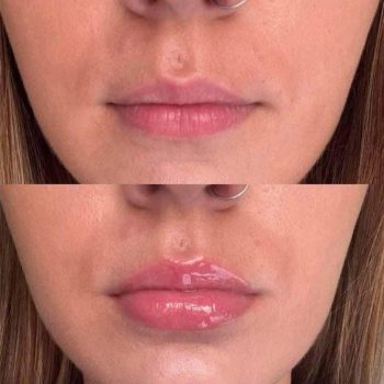 Lip Plumper