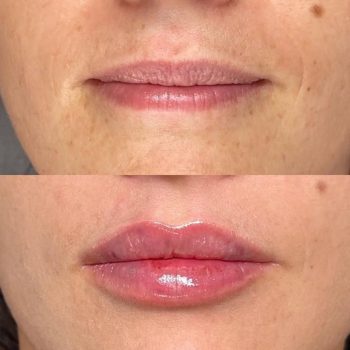 Lip Plumper