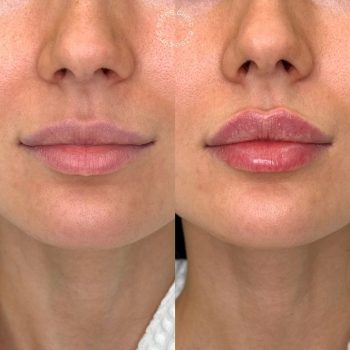 Lip Plumper