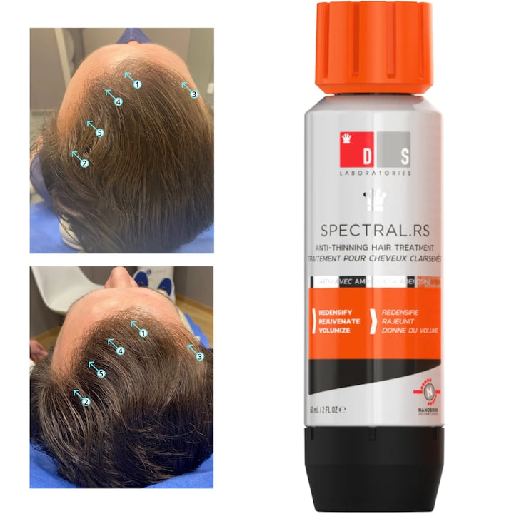 Spectral.RS Ser Antisubtiere fire de par  tratament pentru Intarirea si Regenerarea Firului de Par – Cu Capixyl  Adenozina  Retinol si Peptide  Impotriva Caderii Difuze si Subtierii Parului Cauzate de Dezechilibre Hormonale sau Deficit de Nutrienti  60 ml